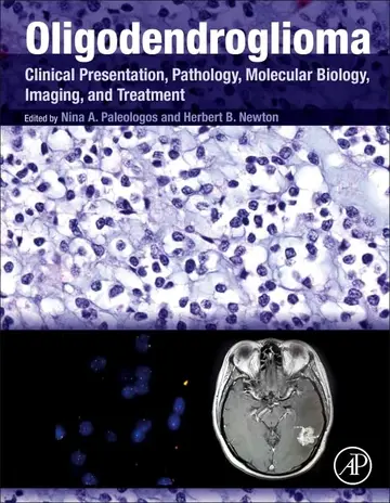 Cover of Oligodendroglioma