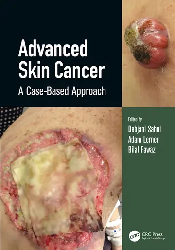 Cover of Advanced Skin Cancer A Case Based Approach