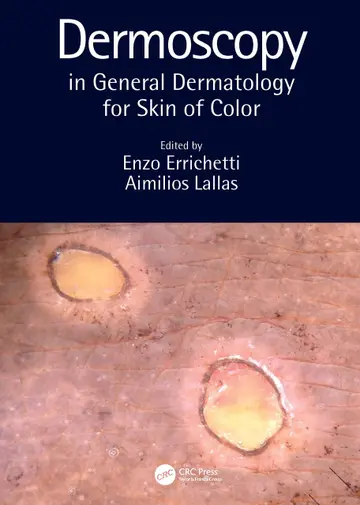Cover of Dermoscopy in General Dermatology for Skin of Color