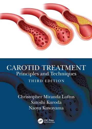 Cover of Carotid Treatment Principles and Techniques 3Ed