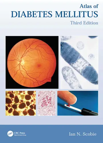 Cover of Old Edition - ATLAS OF DIABETES MELLITUS 3ED