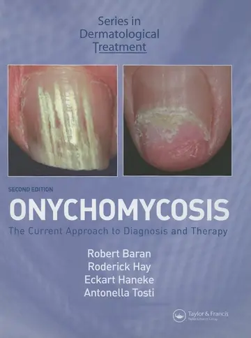 Cover of Onychomycosis