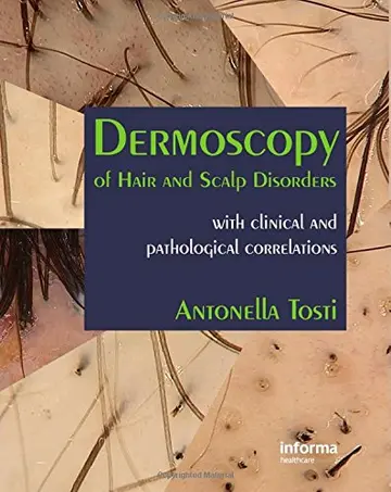 Cover of Dermoscopy of Hair and Scalp Disorders