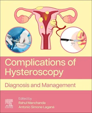 Cover of Complications of Hysteroscopy