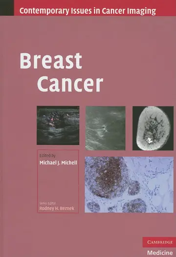 Cover of Breast Cancer