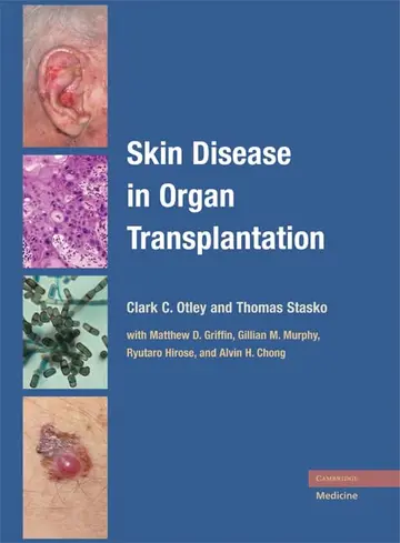 Cover of Skin Disease in ORgan Transplantation