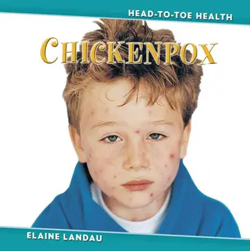 Cover of Chickenpox