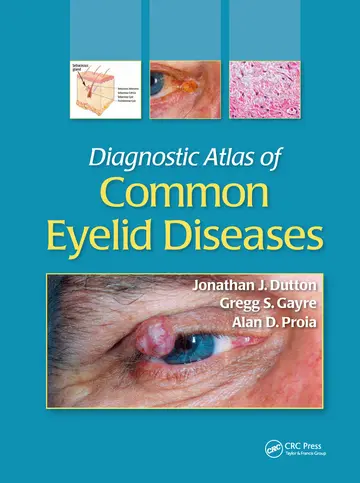 Cover of Diagnostic Atlas of Common Eyelid Diseases