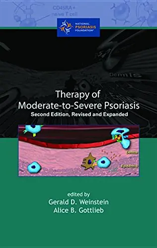 Cover of Therapy of Moderate-to Severe Psoriasis, Revised and Expanded