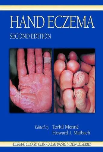 Cover of Hand Eczema