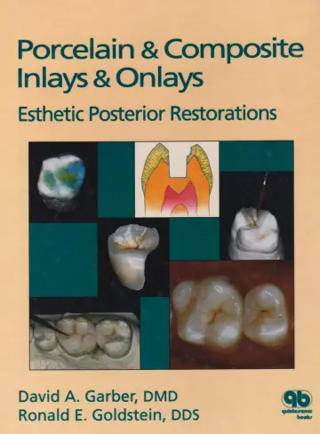 Cover of Porcelain & Composite Inlays & Onlays