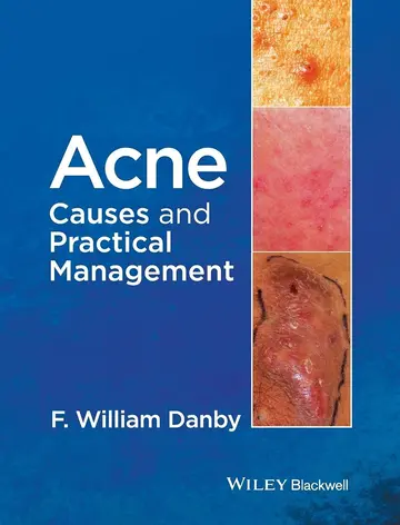 Cover of Acne