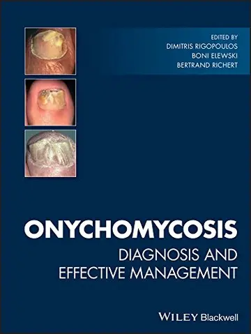 Cover of Onychomycosis