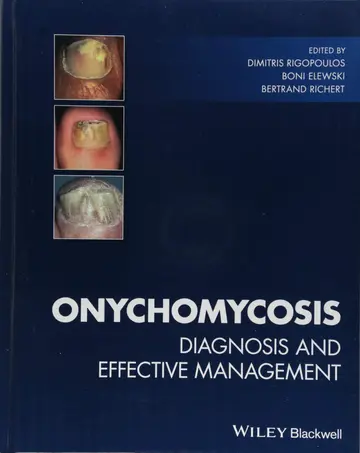 Cover of Onychomycosis