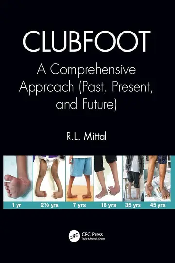 Cover of Clubfoot