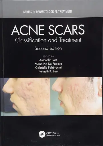 Cover of Acne Scars Classification and Treatment 2ed