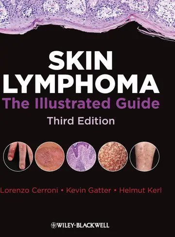 Cover of Skin Lymphoma