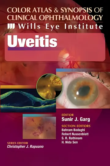 Cover of Uveitis
