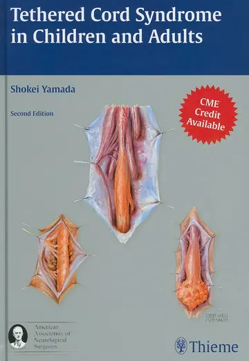 Cover of Tethered Cord Syndrome in Children and Adults