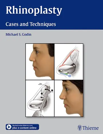 Cover of Rhinoplasty - Cases and Techniques