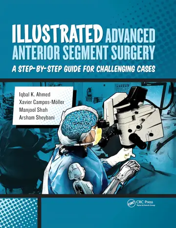 Cover of Illustrated Advanced Anterior Segment Surgery