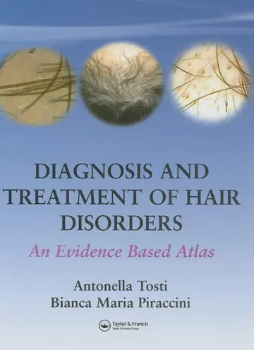 Cover of Diagnosis and Treatment of Hair Disorders