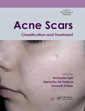 Cover of Acne Scars