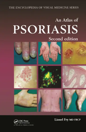 Cover of An Atlas of Psoriasis (Encyclopedia of Visual Medicine)