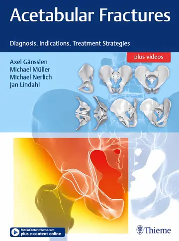 Cover of Acetabular Fractures