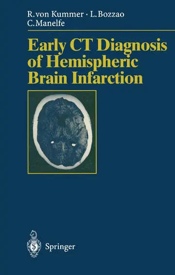 Cover of Early Ct Diagnosis of Hemispheric Brain Infarction