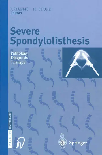 Cover of Severe Spondylolisthesis
