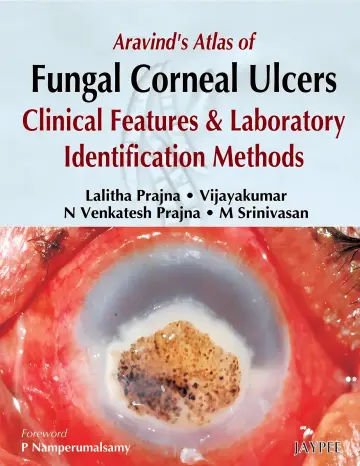 Cover of Aravind's Atlas Of Fungal Corneal Ulcers Clinical Features & Lab.Identification Methods