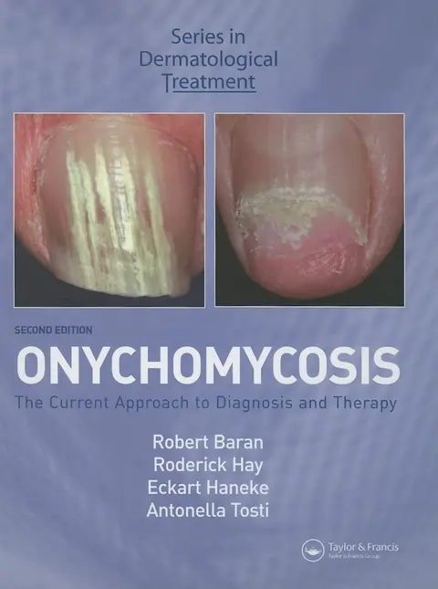 Cover of Onychomycosis