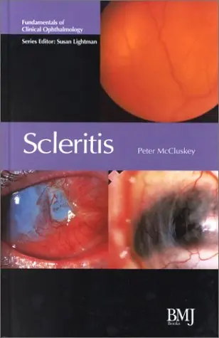 Cover of Scleritis