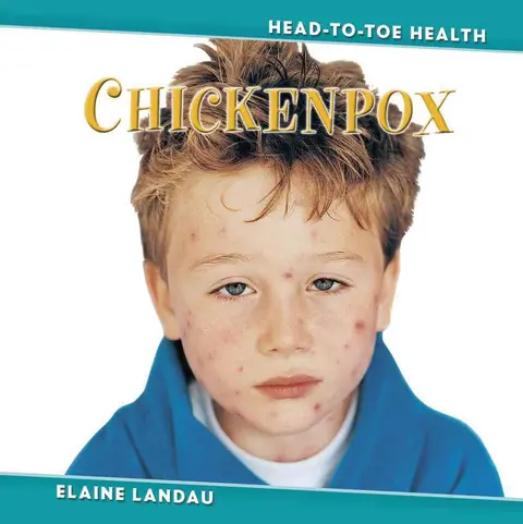 Cover of Chickenpox