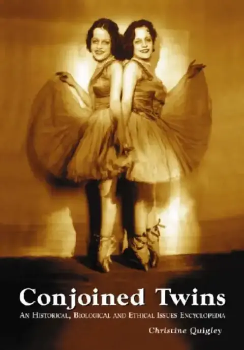 Cover of Conjoined Twins