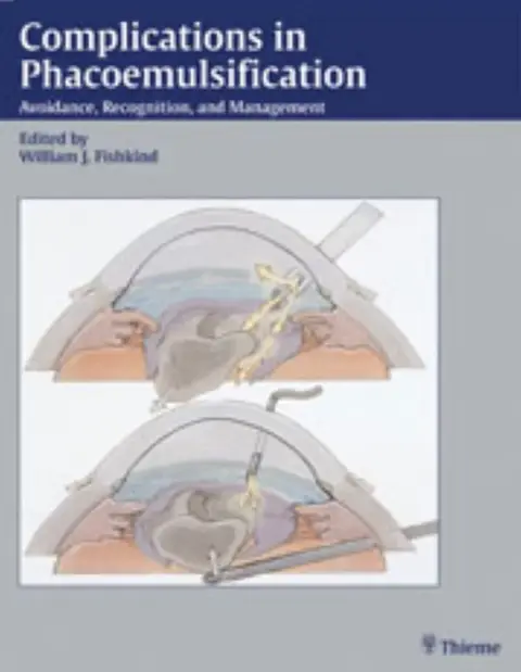 Cover of Complications in Phacoemulsification