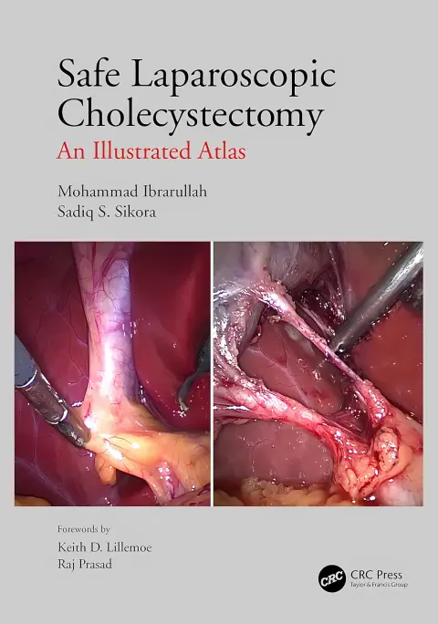 Cover of Safe Laparoscopic Cholecystectomy