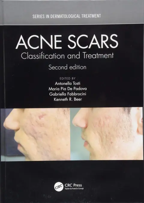 Cover of Acne Scars Classification and Treatment 2ed