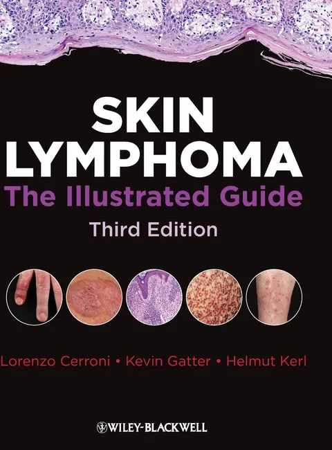 Cover of Skin Lymphoma