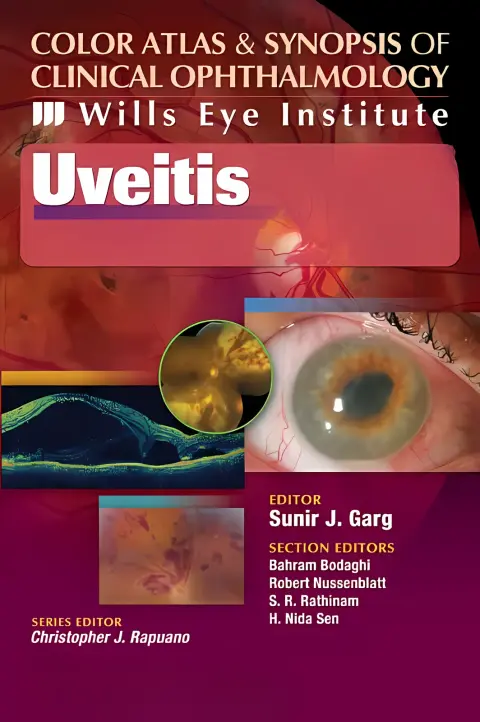 Cover of Uveitis