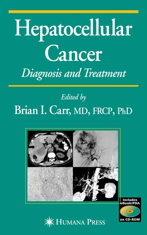 Cover of Hepatocellular Carcinoma