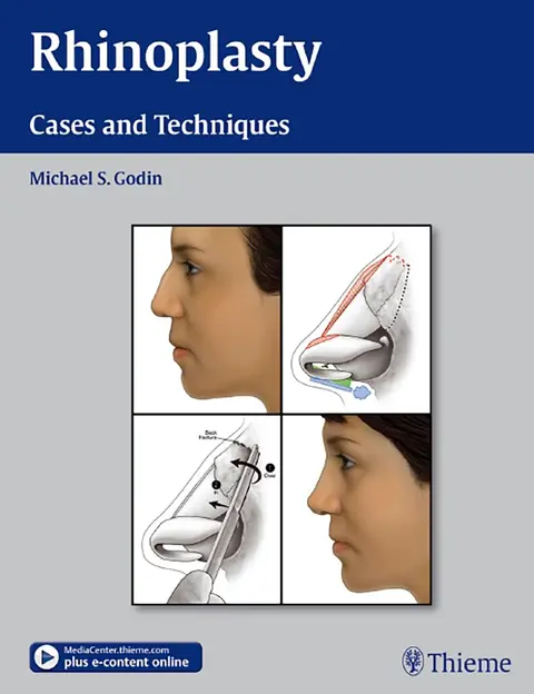 Cover of Rhinoplasty - Cases and Techniques