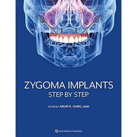 Cover of Zygoma Implants