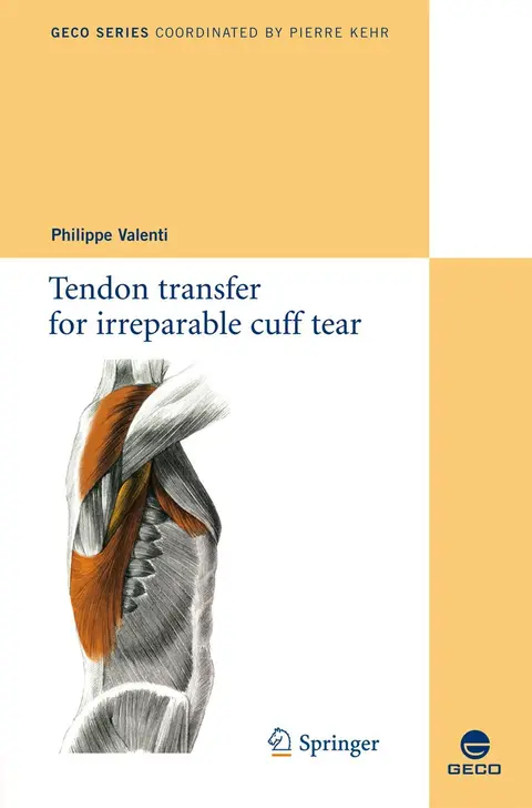 Cover of Tendon transfer for irreparable cuff tear