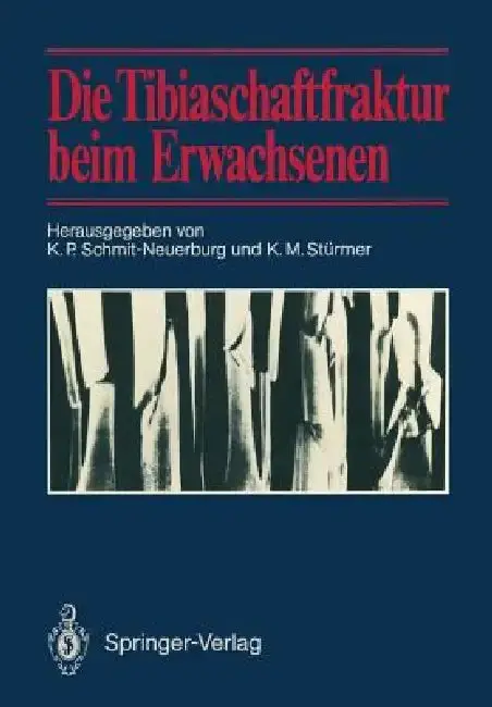 Cover of Die Tibiaschaftfraktur Beim Erwachsenen