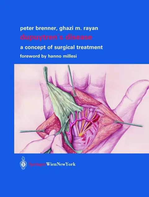 Cover of Dupuytren’s Disease