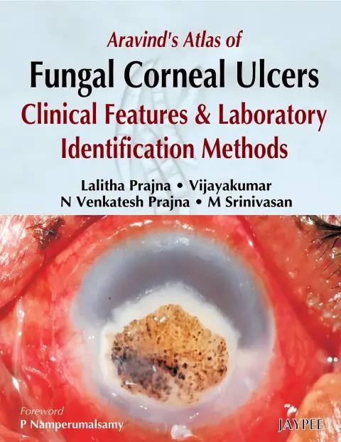 Cover of Aravind's Atlas Of Fungal Corneal Ulcers Clinical Features & Lab.Identification Methods