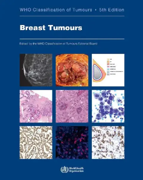Cover of Breast Tumours